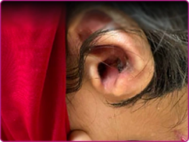 After of a junctional epidermolysis bullosa wound