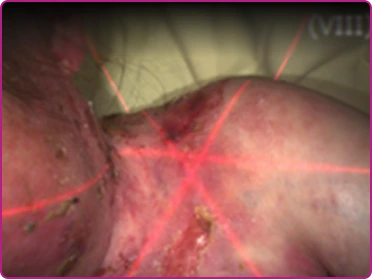After of a recessive dystrophic epidermolysis bullosa wound