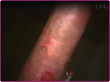 After of a recessive dystrophic epidermolysis bullosa wound