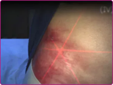 After of a recessive dystrophic epidermolysis bullosa wound