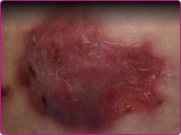 After of a junctional epidermolysis bullosa wound