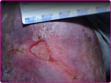 After of a recessive dystrophic epidermolysis bullosa wound