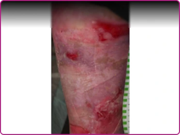 After of a recessive dystrophic epidermolysis bullosa wound