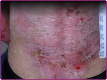 After of a recessive dystrophic epidermolysis bullosa wound