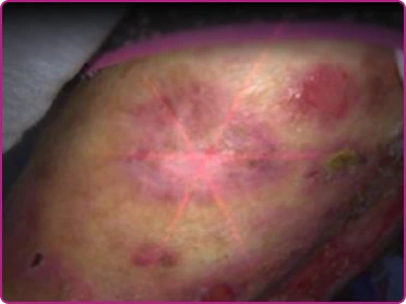 After of a recessive dystrophic epidermolysis bullosa wound