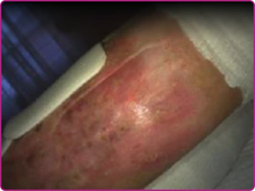 After of a recessive dystrophic epidermolysis bullosa wound