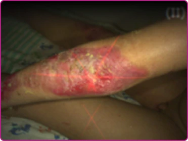 After of a recessive dystrophic epidermolysis bullosa wound