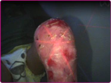 After of a recessive dystrophic epidermolysis bullosa wound