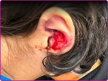 Before of a junctional epidermolysis bullosa wound