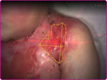 Before of a recessive dystrophic epidermolysis bullosa wound