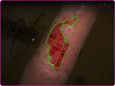 Before of a recessive dystrophic epidermolysis bullosa wound