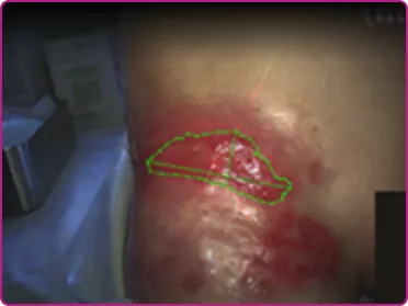 Before of a recessive dystrophic epidermolysis bullosa wound