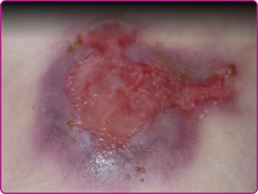 Before of a junctional epidermolysis bullosa wound