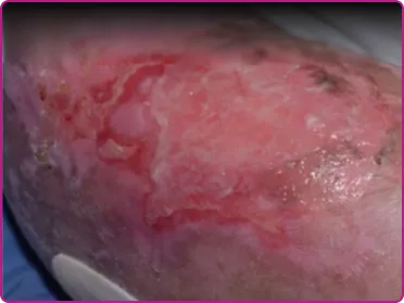 Before of a recessive dystrophic epidermolysis bullosa wound