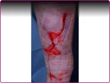 Before of a recessive dystrophic epidermolysis bullosa wound