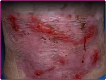 Before of a recessive dystrophic epidermolysis bullosa wound