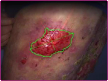 Before of a recessive dystrophic epidermolysis bullosa wound