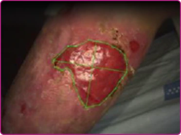 Before of a recessive dystrophic epidermolysis bullosa wound