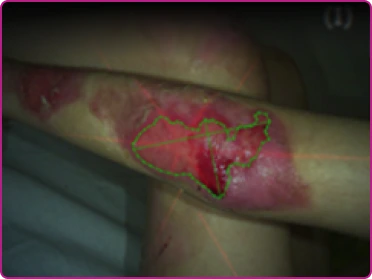 Before of a recessive dystrophic epidermolysis bullosa wound
