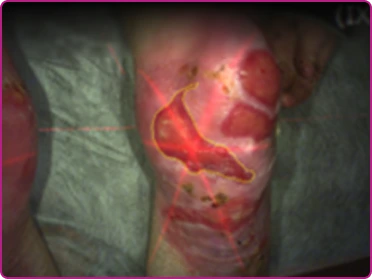 Before of a recessive dystrophic epidermolysis bullosa wound