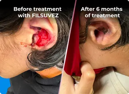 Before and after of a junctional epidermolysis bullosa wound